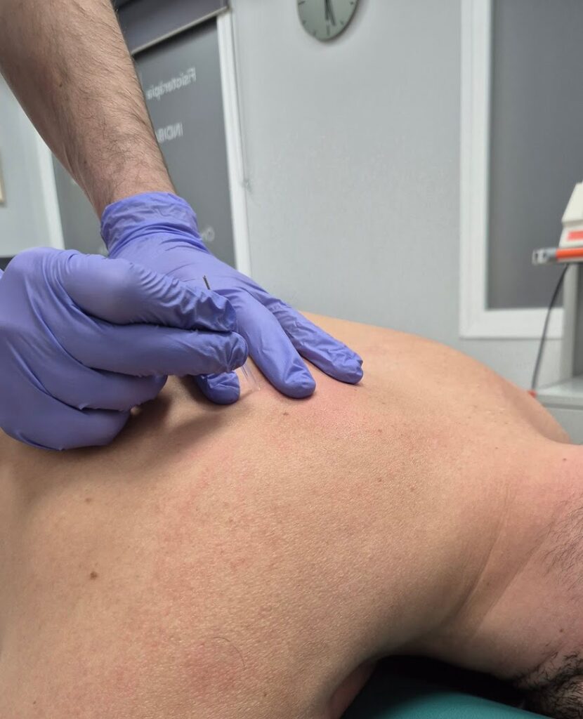 imagen tratamiento punción seca